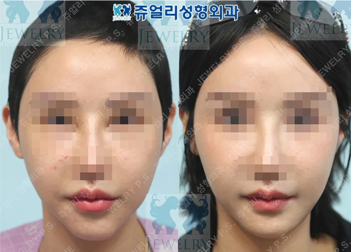輪郭整形の術前・術後写真 1
