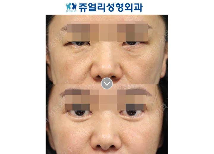 目の整形の術前・術後写真