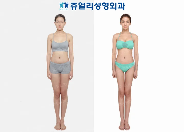 ボディ整形の術前・術後写真 1