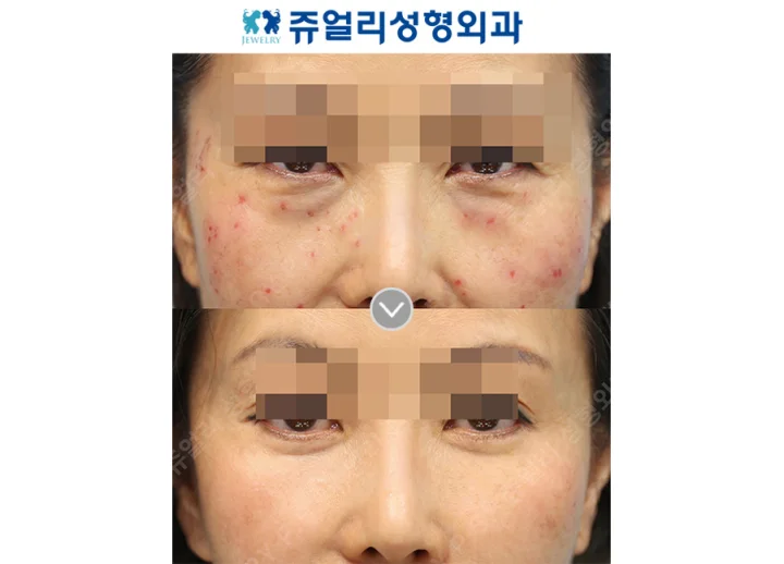 目の整形の術前・術後写真