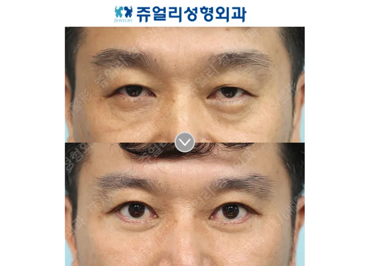 目の整形の術前・術後写真