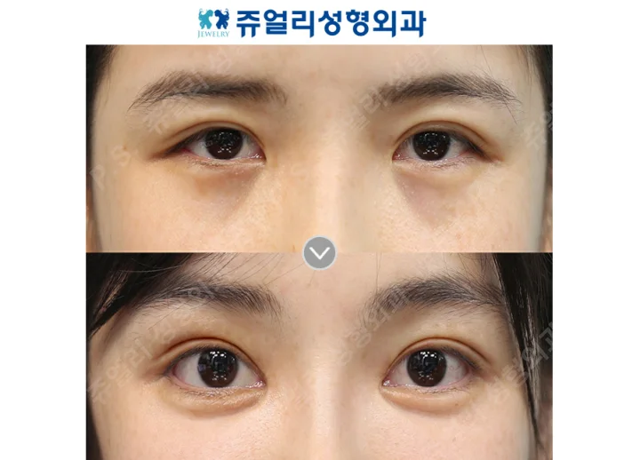 目の整形の術前・術後写真