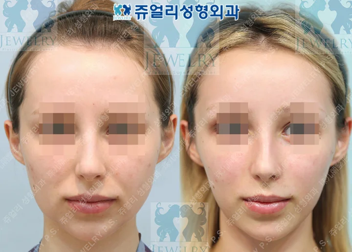 アンチエイジング・リフトの術前・術後写真 1