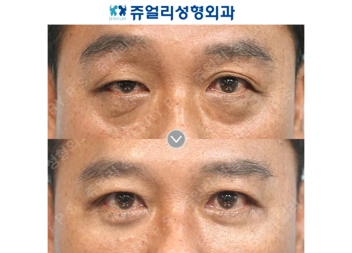 目の整形の術前・術後写真