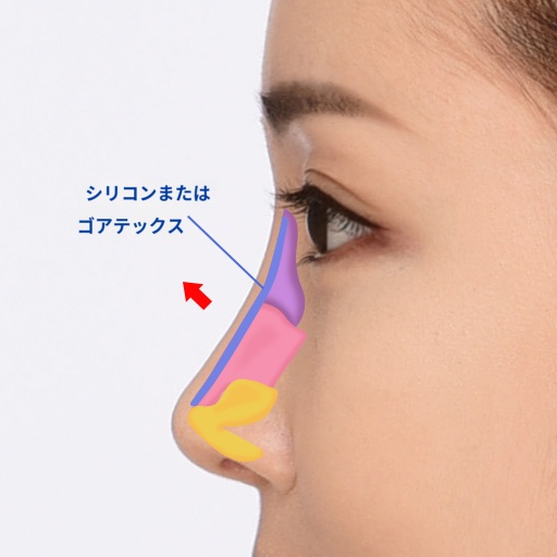 鼻筋のインプラント挿入図