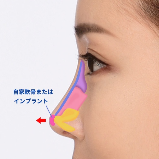 鼻先の自家軟骨または真皮の図