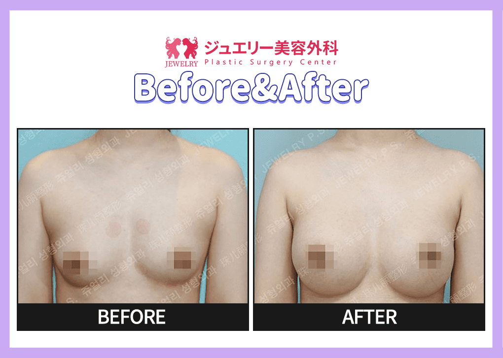 랜딩페이지 전후사진 가슴