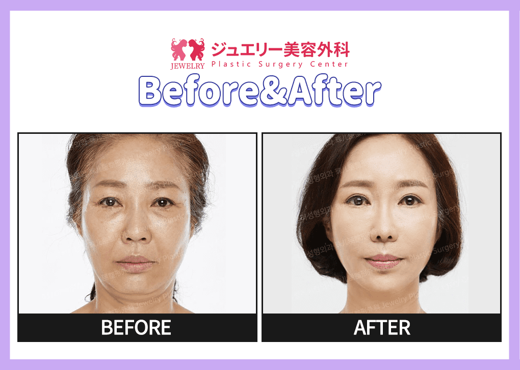 랜딩페이지 전후사진 리프팅