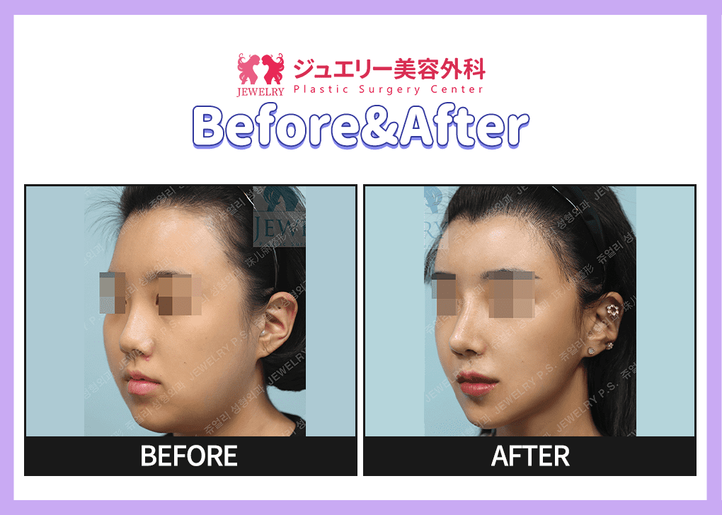 랜딩페이지 전후사진 윤곽 02