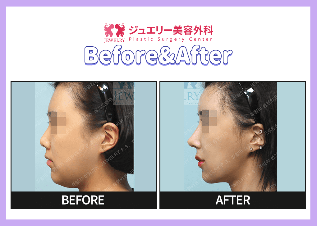 랜딩페이지 전후사진 윤곽 03