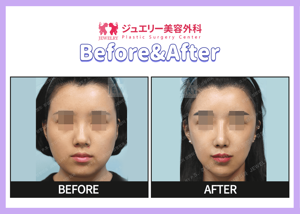 랜딩페이지 전후사진 윤곽