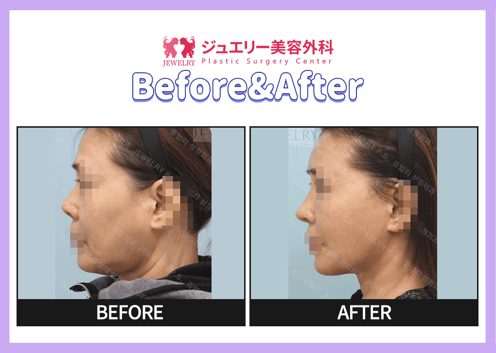 리프팅 전후사진 03