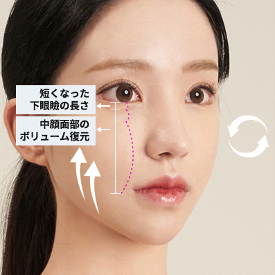 中顔面前頬リフト 05 | ジュエリー美容外科